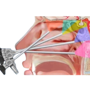 Set endoscópico transnasal Cappabianca Karl Storz