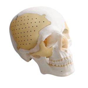 Implante craneal personalizado de Peek Medprin