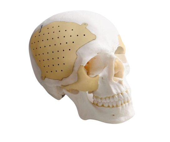 Implante craneal personalizado de Peek Medprin