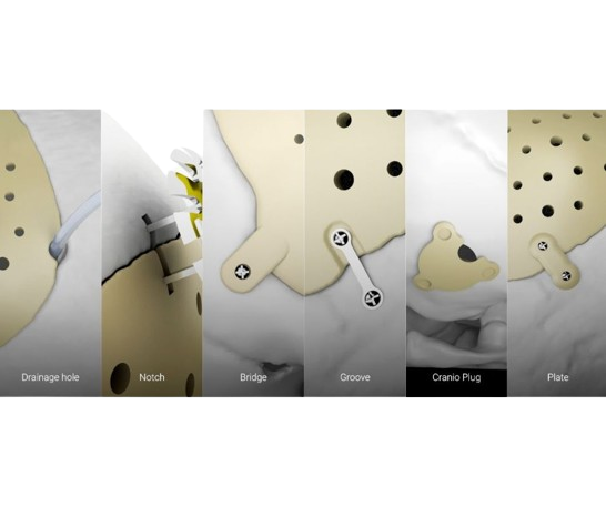 Implante craneal personalizado de Peek Medprin - Image 2