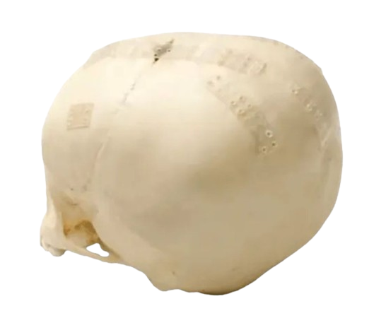 Placas reabsorbibles para craneosinostosis Biomet - Image 2